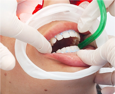 Tooth Contouring